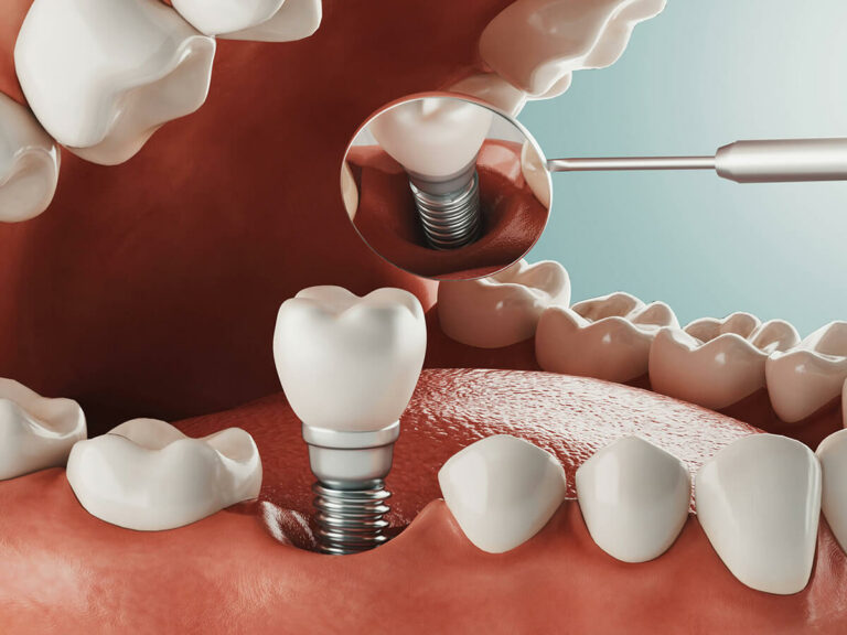 Dental Implants in Hoover, AL at Bluff Park Dental