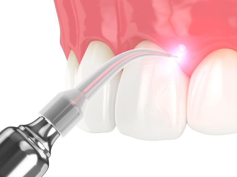 Soft-Tissue Dental Laser in Hoover, AL at Bluff Park Dental