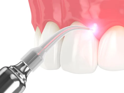 Soft-Tissue Dental Laser in Hoover, AL at Bluff Park Dental